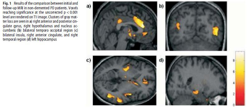 MRI-VBM 2-letá longitudináln lní studie