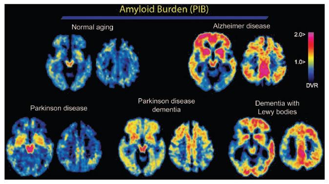 Dg PND, DLB, AN: PIB PET PIB molekula: 11C radioligand s afinitou k amyloidním plakám: : AN A > DLB >