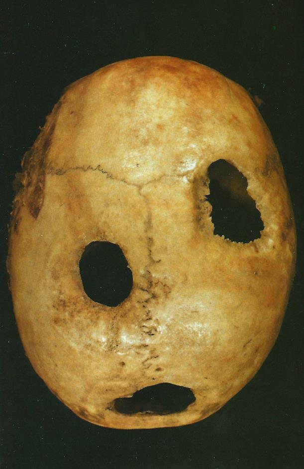 Příloha č. 1 Trepanace lebky. Obr. č. 1 Trepanace lebky. Zdroj: SCHOTT, Heinz.