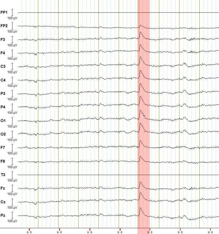 Teoretická část EEG Obrázek 2.1: Ukázka záznamu EEG signálu z programu BrainVision Recorder. (Elektroda FP1 a T3 ještě není zapojená. Zvýrazněná část označuje výskyt artefaktu, konkrétně mrknutí.