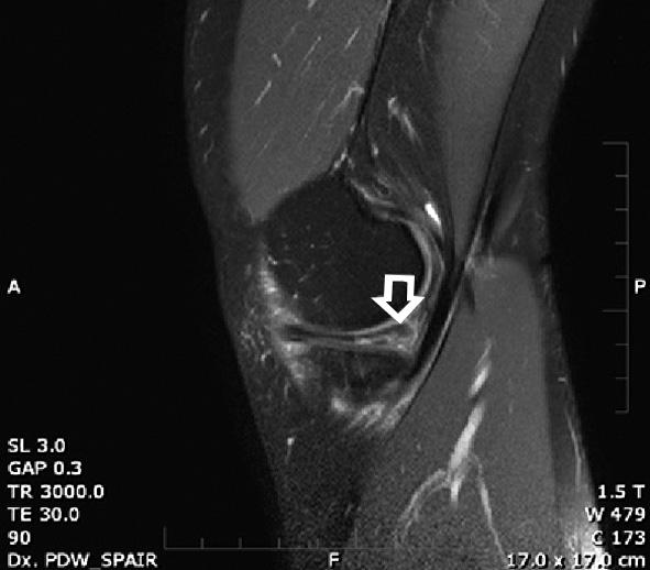 Podle sazebníku výkonů je kód 89713 (MRI jednoho kloubu bez kontrastu) ohodnocen 4976 body (12). To je více než kód 66039 (artroskopie složitá) 4513 bodů (13).