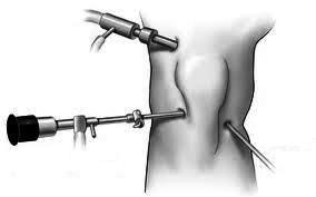 Obr. č. 5 artroskopie kolenního kloubu (Procházka ortopedií, 2012) Poloha pacienta a přístupy Nejčastější a tedy i nejvyužívanější polohou u artroskopie kolenního kloubu je poloha se svěšeným bércem.