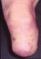kontaktní alergická dermatitida.