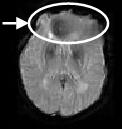 Zkoumání vlivu nepřesností v experimentální stimulaci u fmri Z artefaktů souvisejících s rychlým zobrazováním můžeme pozorovat zejména aliasing a susceptibilní artefakty (geometrické deformace,
