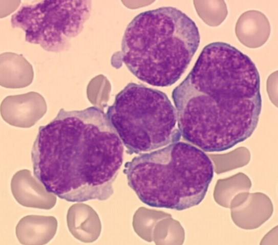 AML M4 AML - prmyelcytární d nádrvé ppulace buněk zahrnvány