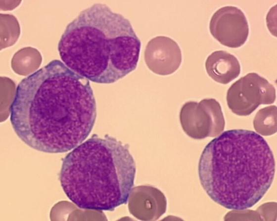 Auervy tyče mrflgické nálezy: AML - myelmnctární většina blastů