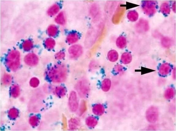 Cytchemické vyšetření zásbníh železa Zásbní želez Fe 3+ : feritin, hemsiderin Princip vyšetření: (Fe 3+ ) + ferrkyanid draselným - K 4 [Fe(CN) 6 ] +