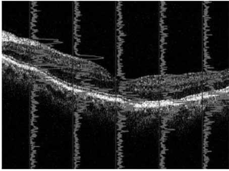 počítač referenční zrcadlo SLD superluminiscenční dioda Převzato se svolením z [1 ]. jem Stratus OCT. Příklad výsledku měření tloušťky RNFL touto technikou ukazuje obrázek 4.