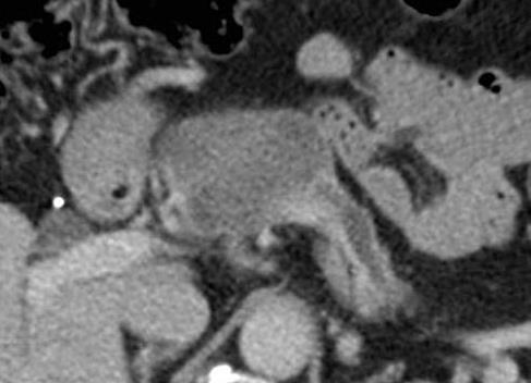 Cystické tumory CT versus MRI CT zobrazí většinu lézí pankreatu, ale někdy není schopno zobrazit