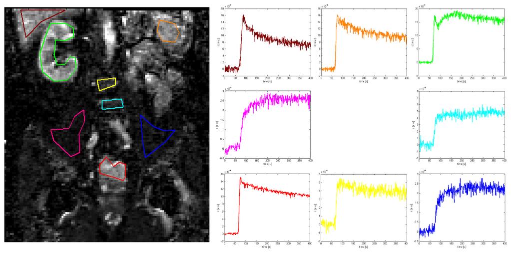 Obr. 1.4 Zisk křivky koncentrace k.l. z dynamické sekvence Ilustraci tvaru křivek pro různé tkáně ukazuje Obr. 1.5 Obr. 1.5 - Křivky koncentrace k.l. různých tkání Červená je oblast nádoru, zelená je ledvina, růžová a tmavě modrá je sval, žlutá a světle modrá je signál z páteře a hnědá jsou játra.