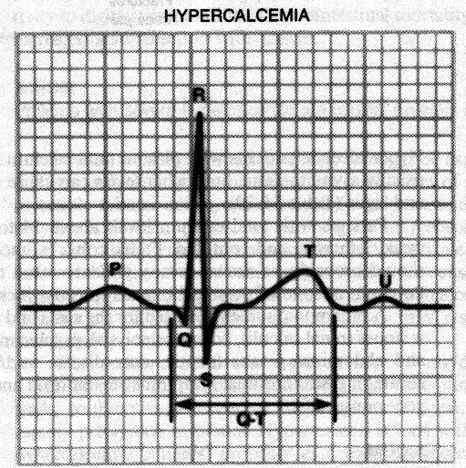 pancreatitis provází hypomagnesémii