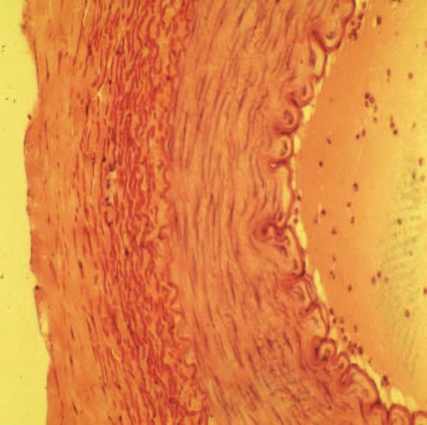 ileofemorální tepny v místě větvení tepen v žilních štěpech umístěných do arteriální