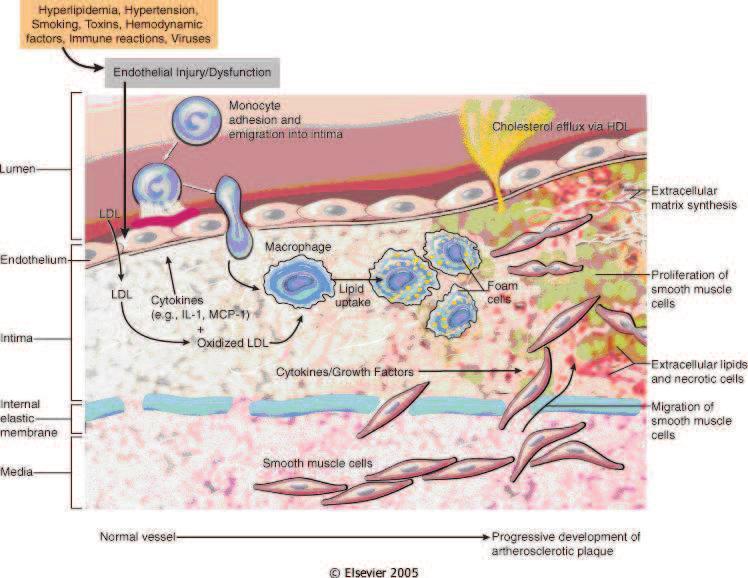 aterosklerotických plátů v cévní stěně Patogeneze chronický progredující proces již od