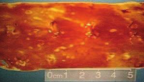 atherom V. fibroatherom VI.