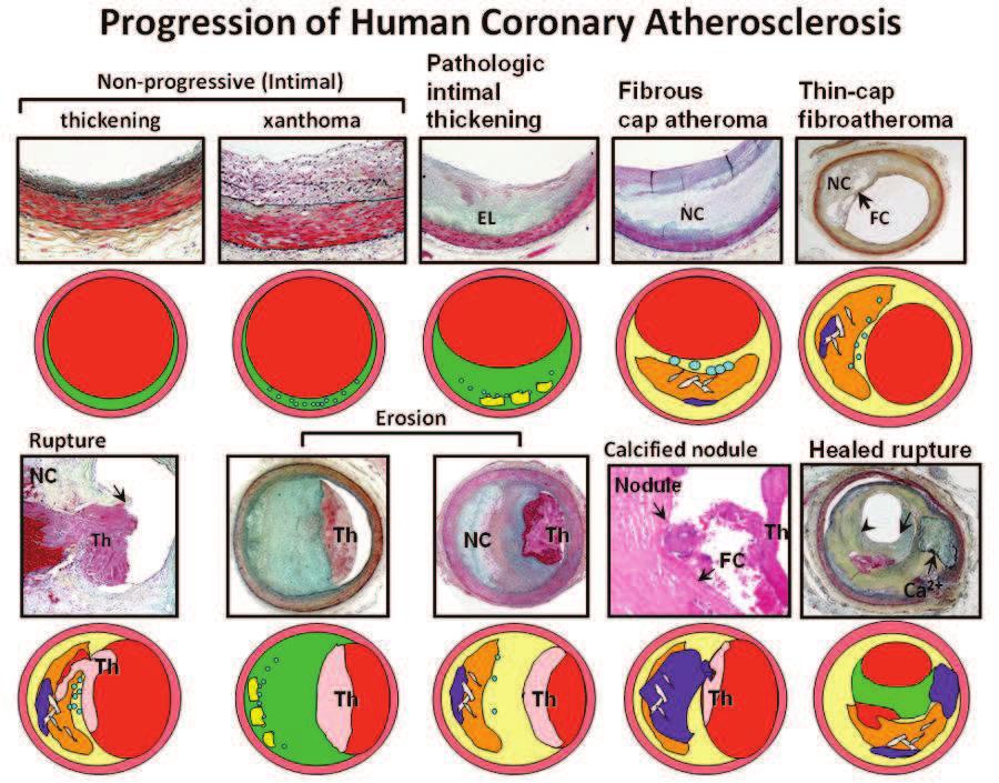 plát Progrese aterosklerózy