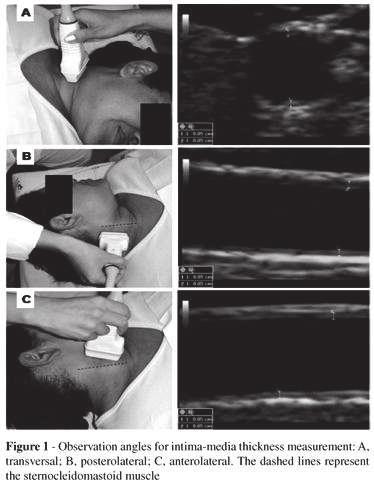 (intima media thickness) CT