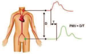 rychlost pulzní vlny ABI