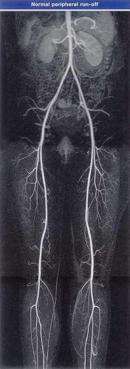MR angiografie - Nejde o RTG metodu - Použití nízkých dávek nízkorizikového MR kontrastu - Vyšetření možno provést bez kontrastu - Kalcifikace neovlivňuji vyšetření -