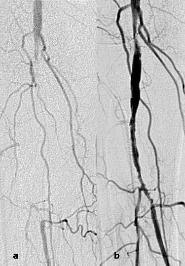 Etiologie AS Embolie Cystickou degeneraci