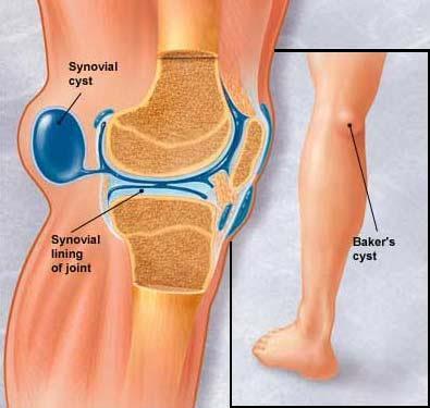 Etiologie AS Embolie Cystickou degeneraci medie