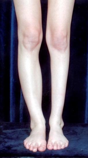 V kombinaci s kapsulotomiemi rigidních kloubů jsou výsledky i u těžkých a zastaralých deformit přijatelné (Grill, 1984). 4.