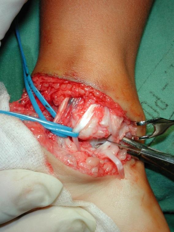 6.2 Klasifikační metody a biomechanické parametry Počáteční klasifikace deformity, charakterizující postavení kostí, se provádí pomocí radiografie; vyšetření se soustředí především na kost patní a