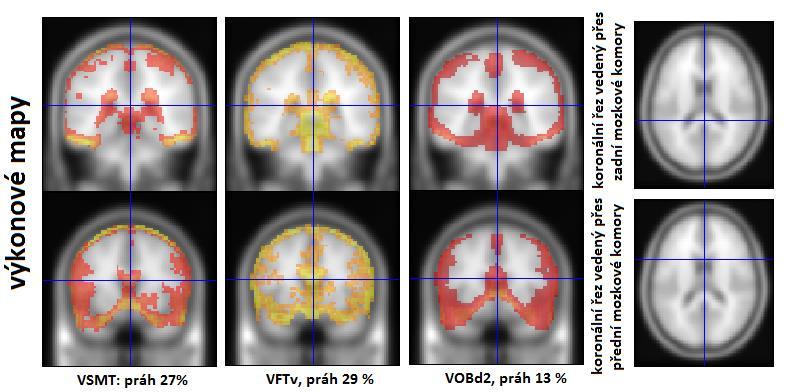 4 Interpretace statistických map skupinové analýzy Statistické mapy získané při skupinové analýze vyjadřují, zda v daném voxelu bylo u všech subjektů ve studii zaznamenáno statisticky významné
