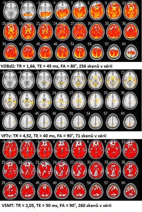 Obrázek 37: Srovnání výsledných map skupinové statistiky mezi studiemi, prahování na hladině p=0,001(f>2,159) Na obr. 37 je patrné, že projev pohybových artefaktů se v rámci jednotlivých studií lišil.