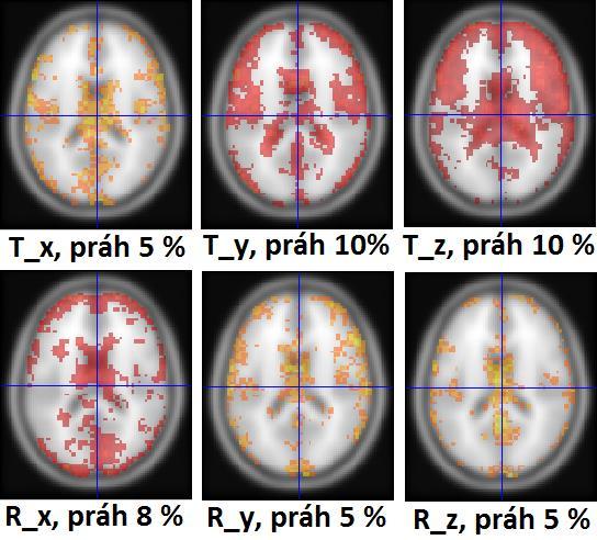 Pohybové parametry a jejich druhé mocniny spolu vykazují jistou míru korelace a v některých voxelech mohou být odhadnuty váhy těchto regresorů s opačným efektem, což vede k výsledným antikorelacím