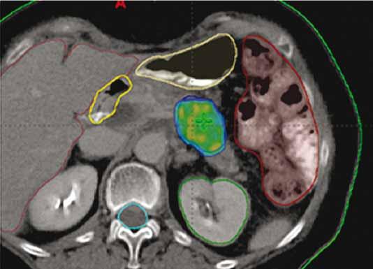 EXTRAKRANIÁLNÍ STEREOTAKTICKÁ RADIOTERAPIE PŘEHLED SOUČASNÝCH INDIKACÍ Obr. 3. SBRT adenokarcinomu na pomezí těla a kaudy pankreatu u 67leté pacientky po neoadjuvantní chemoterapii.