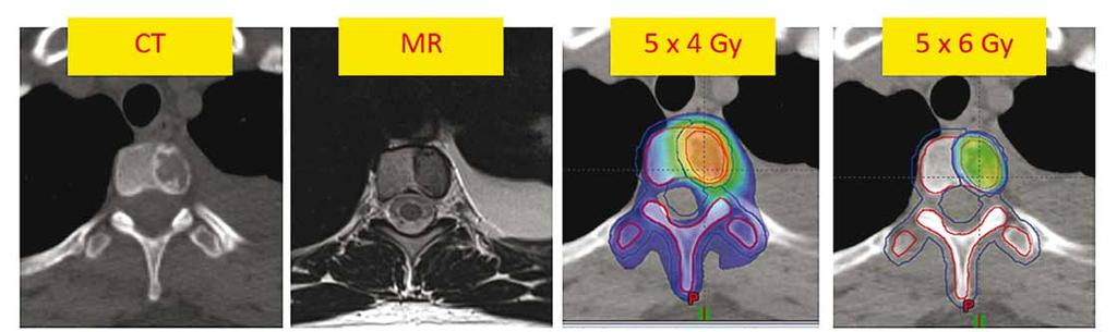 EXTRAKRANIÁLNÍ STEREOTAKTICKÁ RADIOTERAPIE PŘEHLED SOUČASNÝCH INDIKACÍ CT MRI 5 4 Gy 5 6 Gy Obr. 8. Solitární metastáza v obratli Th6 u 44leté pacientky s lobulárním karcinomem levého prsu.