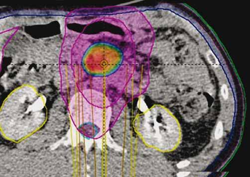 PTV plánovací cílový objem, Gy Gray Gynekologické nádory SBRT lze použít v případech, kdy není možné u lokálně pokročilých karcibýt koncipovány tak, aby mohly prokázat nejen význam systémově
