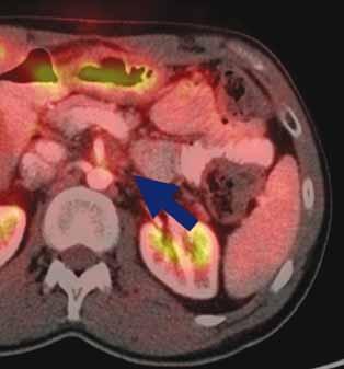Obecně se nedoporučuje překročit v rizikových strukturách (organ at risk OAR) jednotlivou dávku 2,5 Gy; jednotlivá dávka nad 4 Gy by v OAR měla být určitě minimalizována.