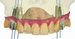 ODBORNOST DESIGN A VÝROBA IMPLANTOLOGICKÉ ŠABLONY Důležitým faktorem pro zhotovení šablony je kromě intraorálního skenu také CT sken, které se navzájem propojí v