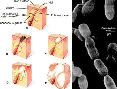 Propionibacterium acnes výskyt: na kůži, nosohltan, spojivkový vak, zažívací trakt jeden z faktorů