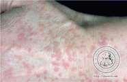 epidermodysplasia
