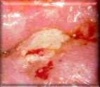 RLP HPV 6,