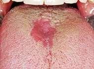 erythroleukoplakie