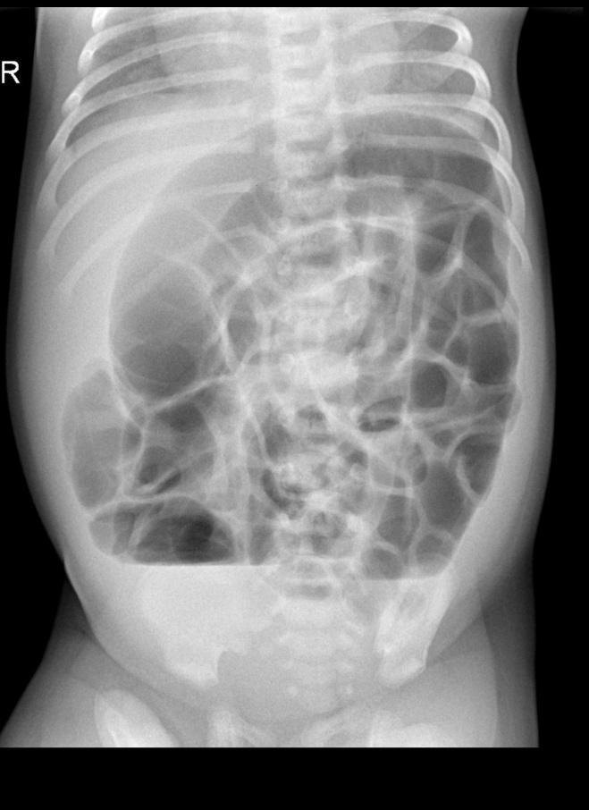 3) Obstrukce? (úplná vs. neúplná, vysoká vs.