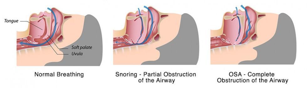 OBSTRUKČNÍ SPÁNKOVÁ APNOE Porucha dýchání ve spánku, opakovaný kolaps horních cest dýchacích (uvula, jazyk a měkké patro )
