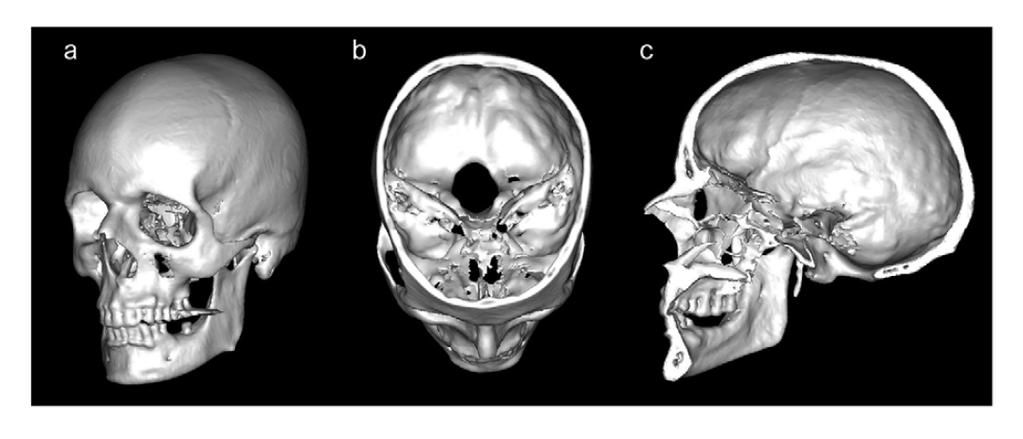 Obrázek 2 Trojrozměrné zobrazení vnitřních struktur lebky a) celý 3D virtuální model, b) koronární řez, c) sagitální řez (podle MANTINI ET AL., 2009).