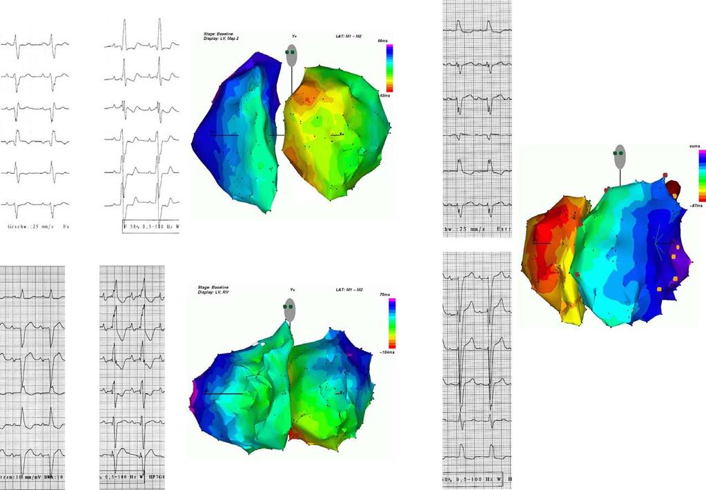 534 Circ Arrhythm Electrophysiol June 2014 A C Downloaded from http://circep.ahajournals.org/ by guest on April 19, 2017 B Figure 1.