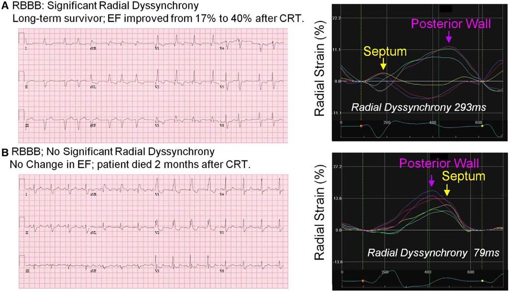 536 Circ Arrhythm Electrophysiol June 2014 Downloaded from http://circep.ahajournals.org/ by guest on April 19, 2017 Figure 2.
