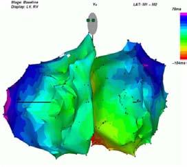 activation delay of the left ventricle (LV). RV indicates right ventricular.