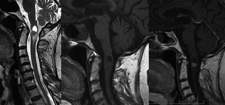 Obr. 7. Hemangioblastom krční míchy, MR zobrazení v sagitální rovině, T2 vážená sekvence a T1 vážená sekvence nativně a po i. v. aplikaci kontrastní látky.
