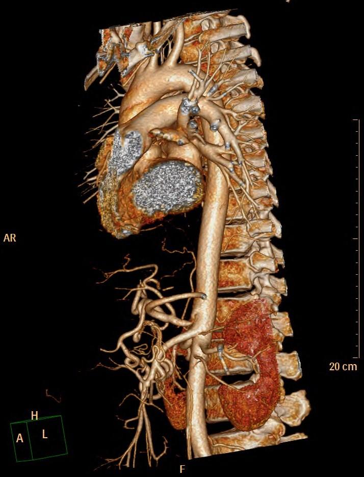 Břišní aorta 1. Nepárové viscerální Tr.coeliacus A.mesenterica sup. A.mesenterica inferior 2. Párové viscerální Aa.