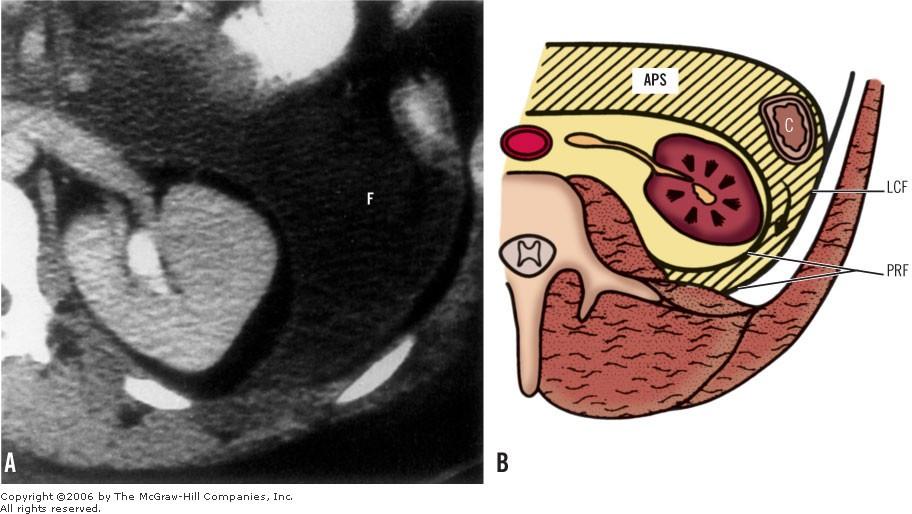 Retrorenal extension of pancreatitis fluid. A, CT scan shows fluid (F) in left anterior pararenal space extending posterior to kidney, producing characteristic wedge-shaped appearance.