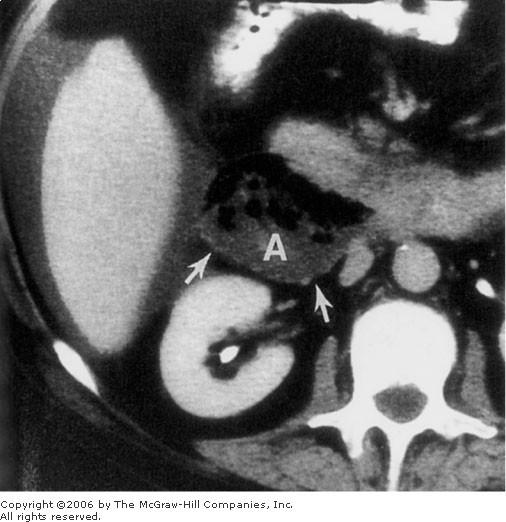2. Abscess in anterior pararenal space. CT scan shows fluid and gas bubbles (A) between duodenum, liver, and right kidney. Anterior renal fascia (arrows) forms posterior border of abscess.