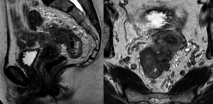 Obr. 5. Vlevo T2 vážené obrazy v sagitální rovině, vpravo T2 obrazy axiálně, sledovatelná je jednoznačná invaze nádorových hmot do dorsální stěny dělohy stadium T4b Obr. 6.