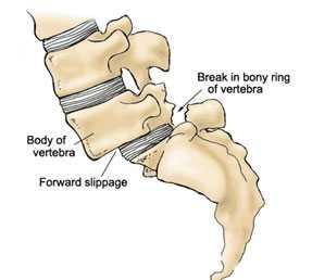 Traumatická spondylolistéza Akutní traumatická olistéza: ruptura intervertebrálního disku, odlomeni oblouků a dolních kloubních výběžků (pars interarticularis) Stress fracture : nejčastěji v úrovni